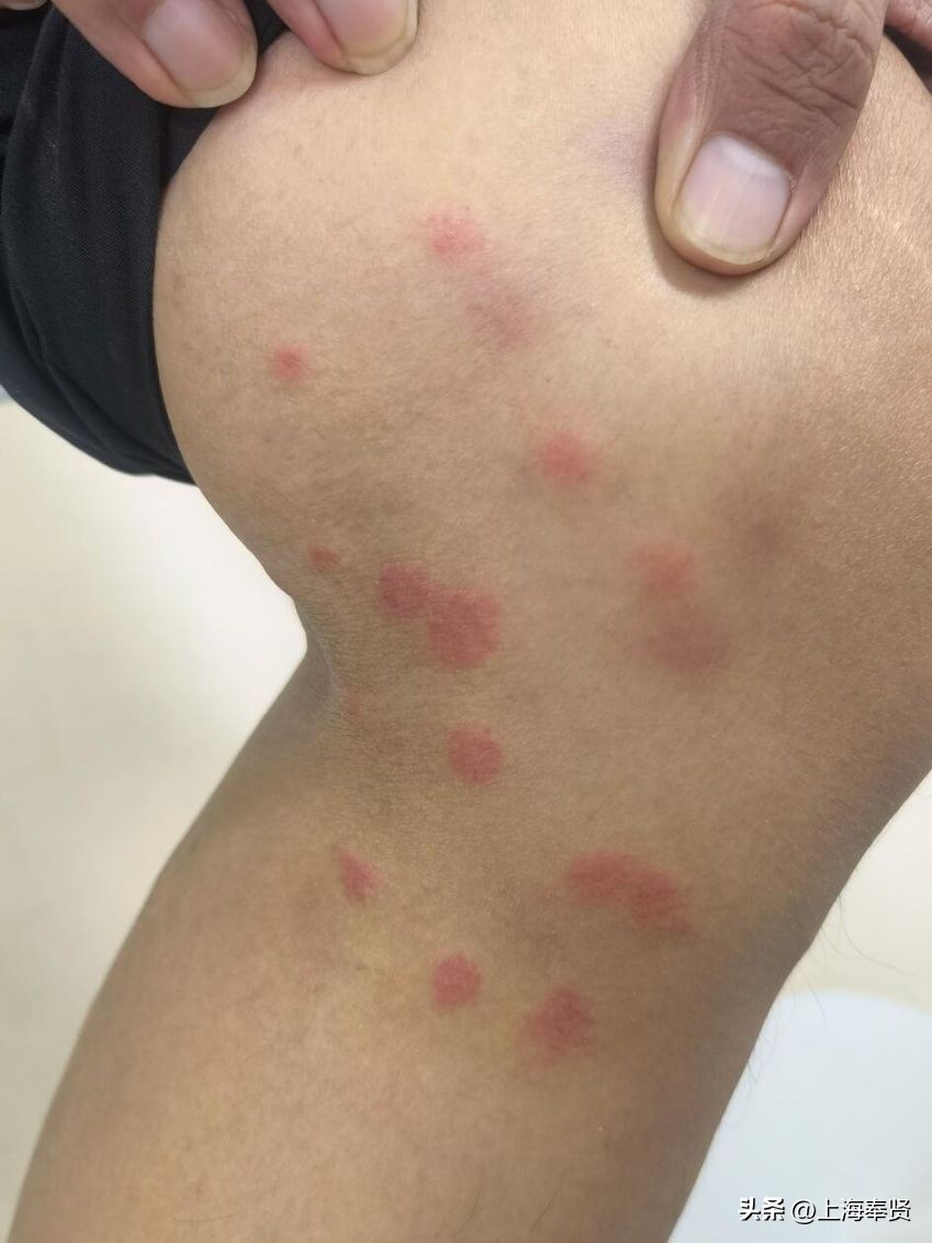夏季被虫子咬了怎么办,夏季皮肤病攻略虫咬感染篇