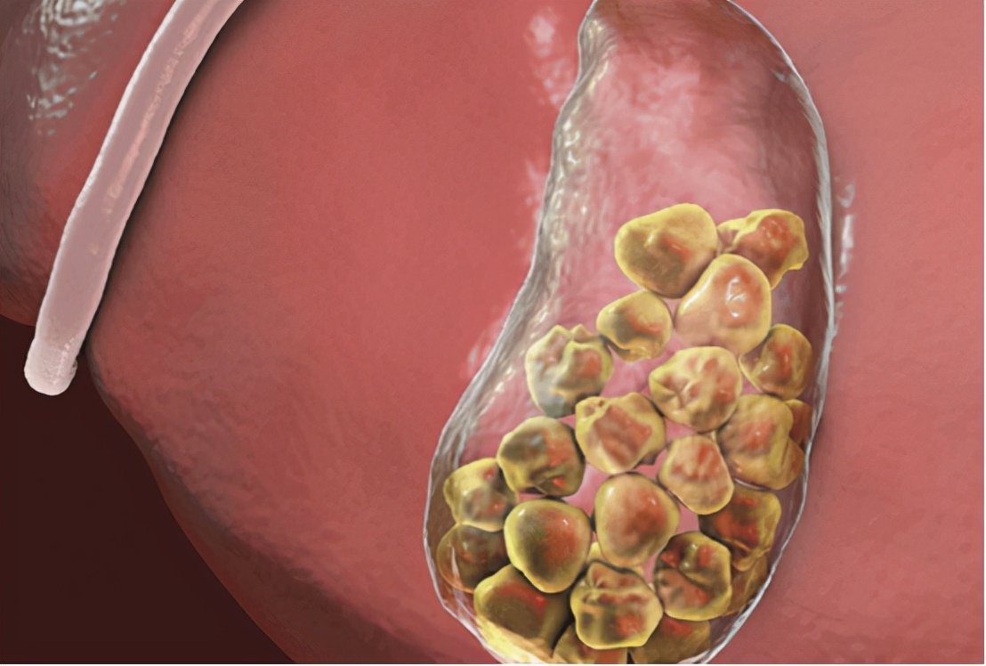 奥美拉唑一停药胃酸怎么处理,奥美拉唑一停药就胃胀复发