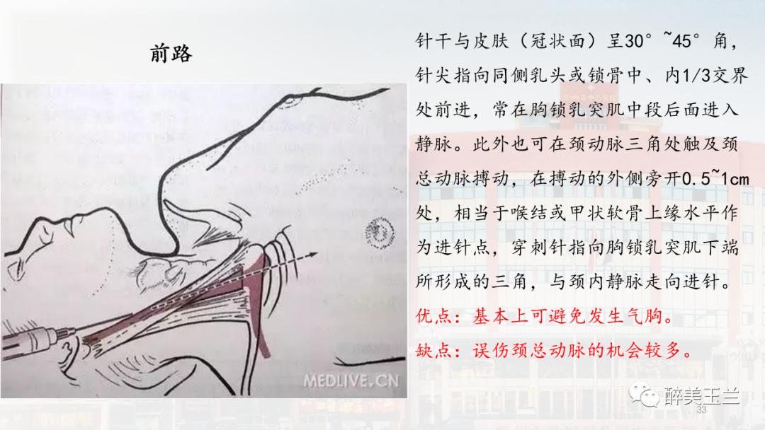 深静脉穿刺置管术讲解ppt,中心静脉穿刺置管深度