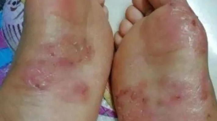 日本人如何处理脚气问题,欧美人为什么更容易患脚气