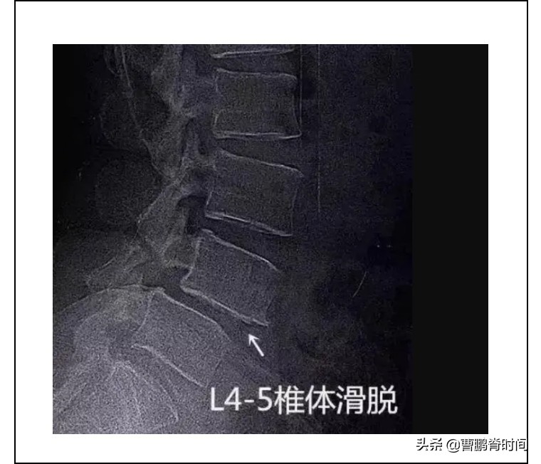 儿童腰痛警惕四种病,小儿腰痛科普