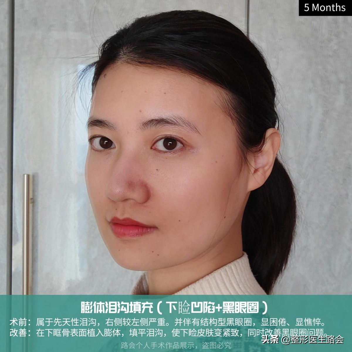 29岁眼袋黑眼圈泪沟严重怎么处理,35岁做泪沟眼袋最好的方法