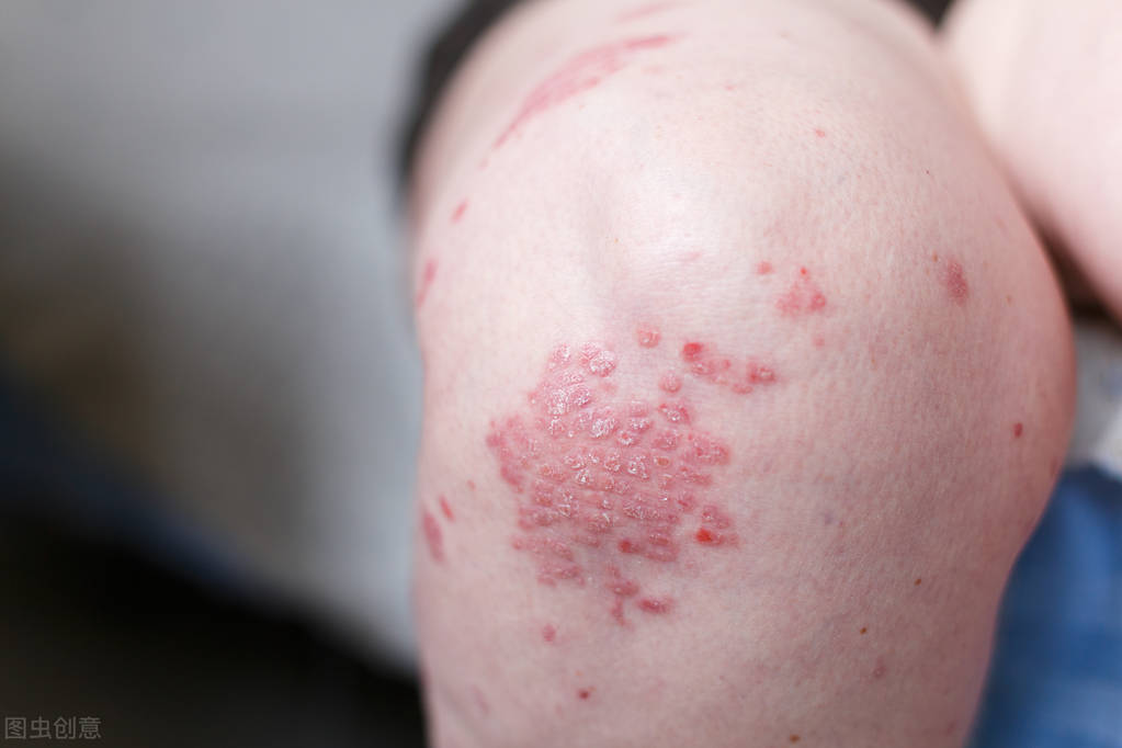 湿疹患者容易有哪些误区呢,湿疹的误区