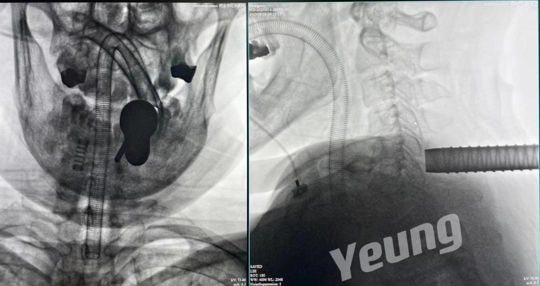 西安椎间孔镜手术治疗颈椎,西安红会医院微创