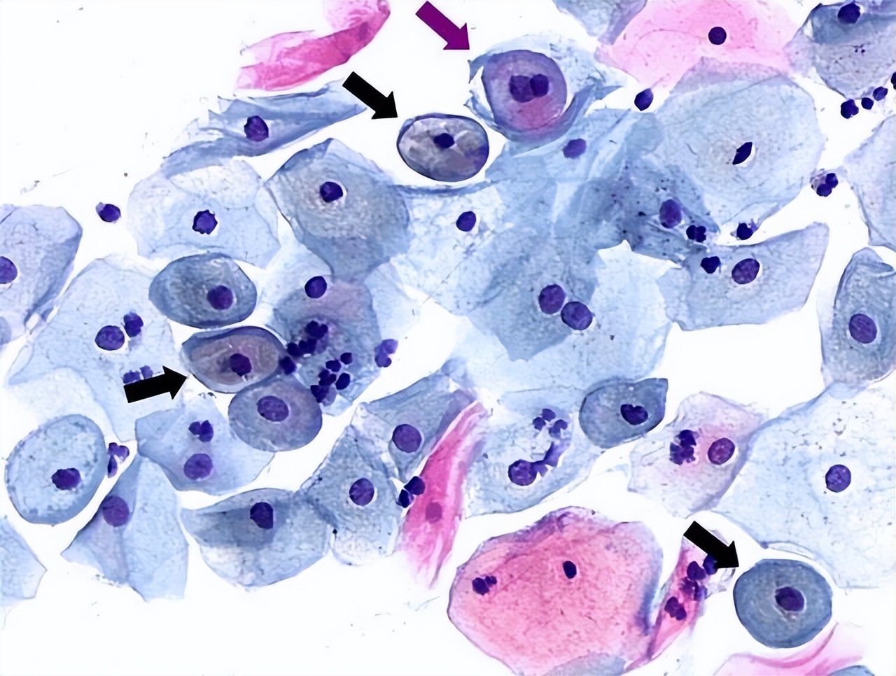 hpv58tct检测有轻度炎症,TCt轻度炎症是异常么