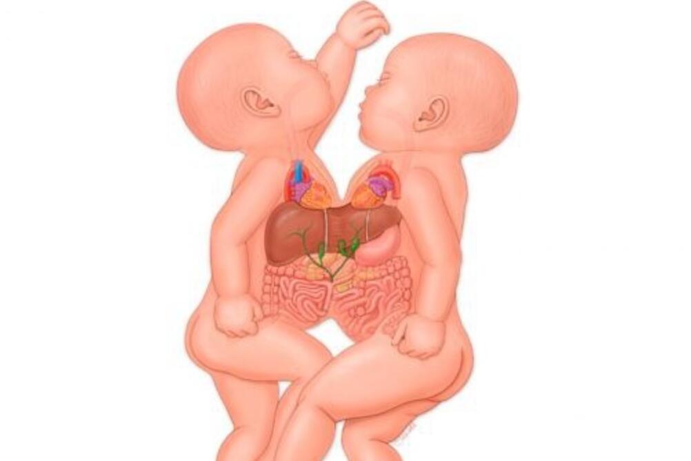 连体人该怎么结婚生子,邦克兄弟连体人