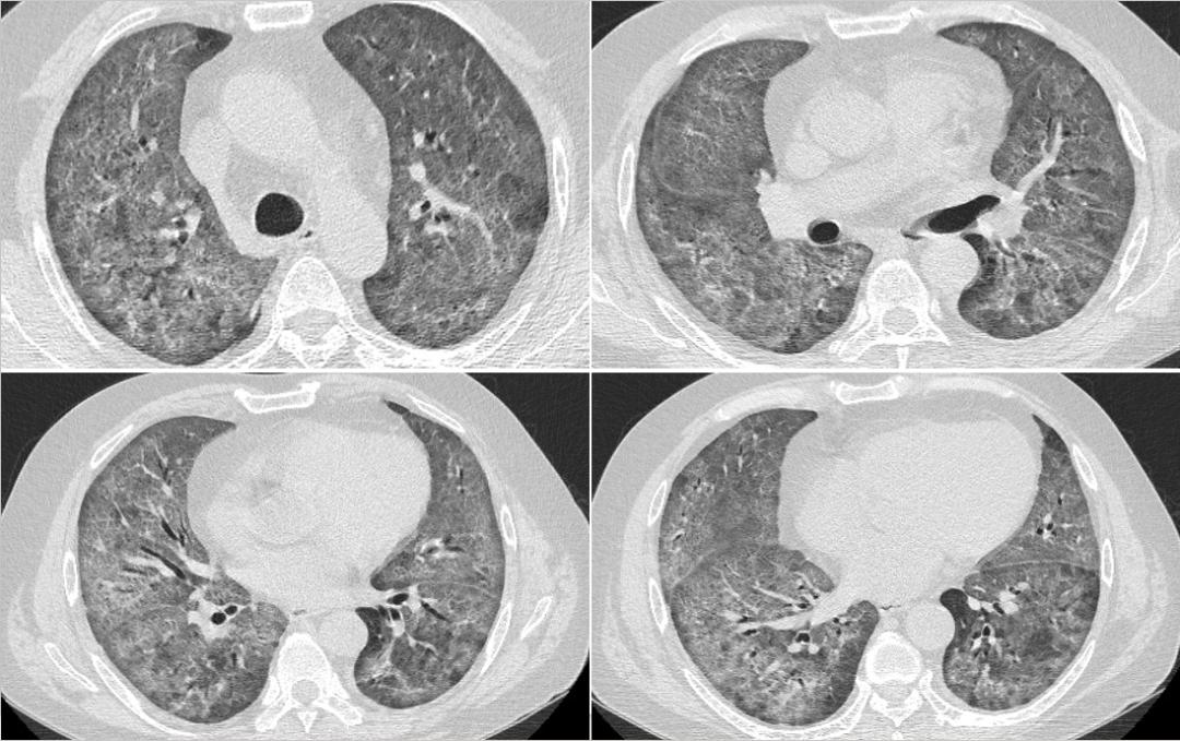 hiv感染肺孢子菌肺炎,hiv患者检查出耶氏肺孢子菌