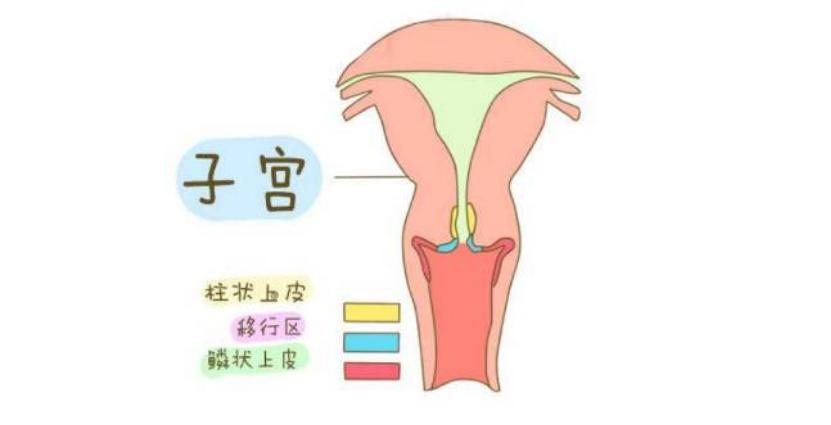 宫颈糜烂和生活作风有关吗,宫颈糜烂是不注意卫生得的吗