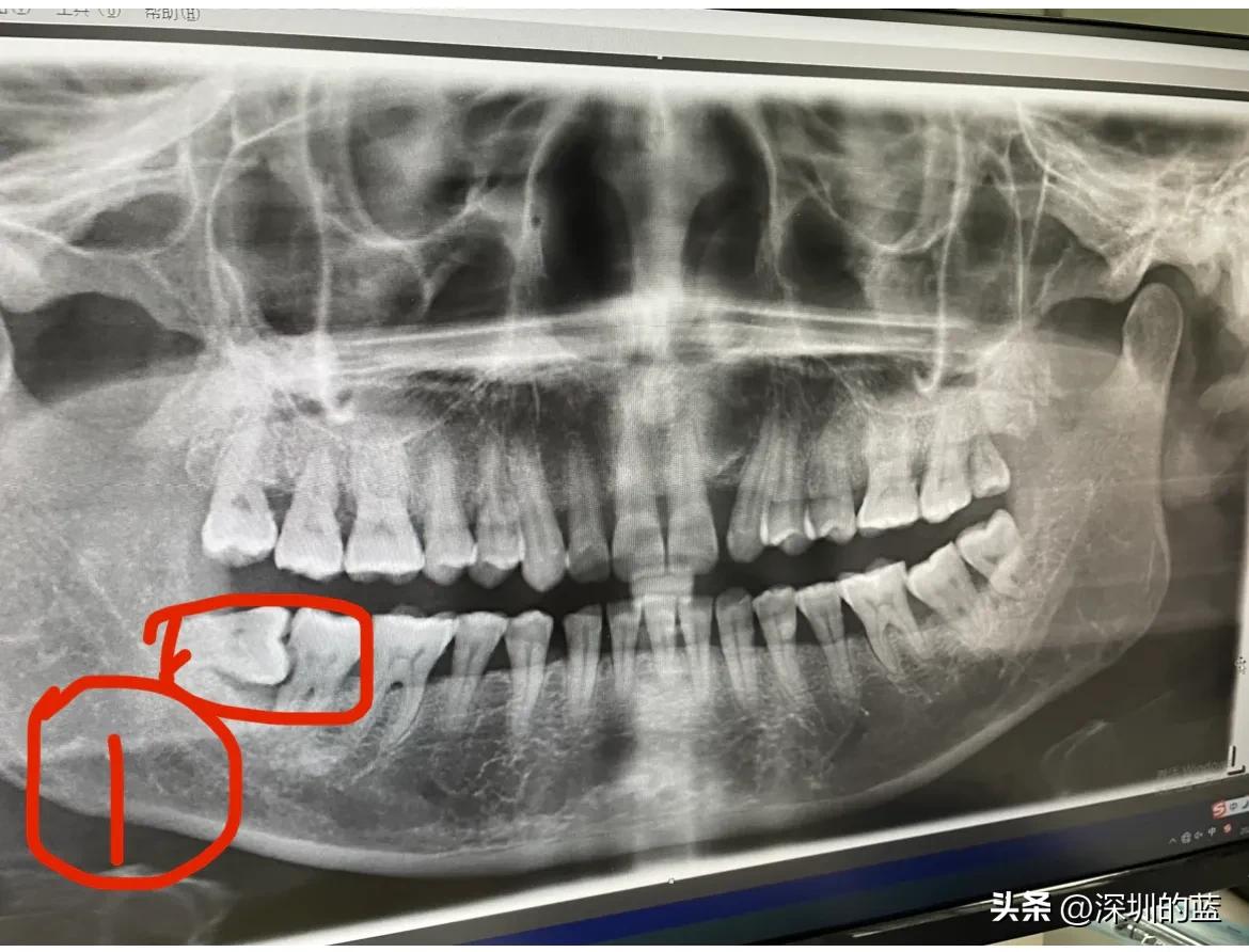 拔除智齿解决了多年的口臭,拔掉四颗智齿意外治好了口臭