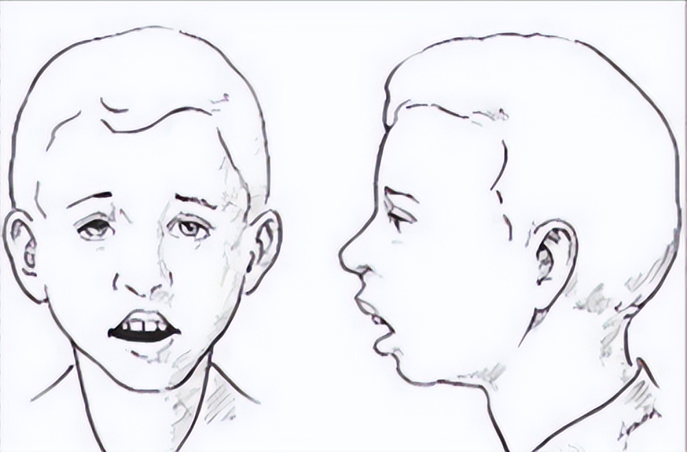 小孩子鼻炎能根治吗,鼻炎鼻塞20秒自愈方法