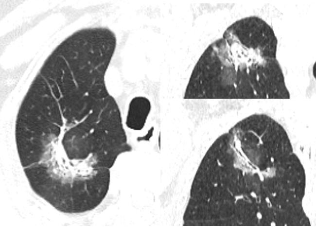 机化性肺炎用药多久复查ct,坠积性肺炎ct表现