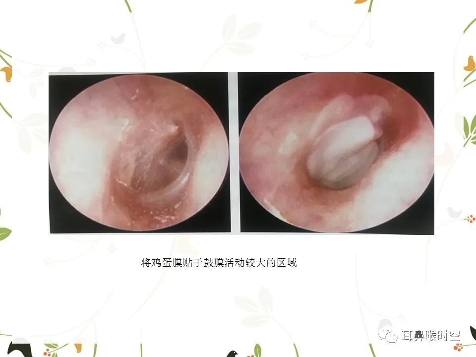 鼓膜可见穿孔,鼓膜穿孔听力下降能恢复吗