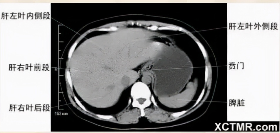 胸腹部盆腔ct主要检查什么,女性盆腔ct断层解剖结构图