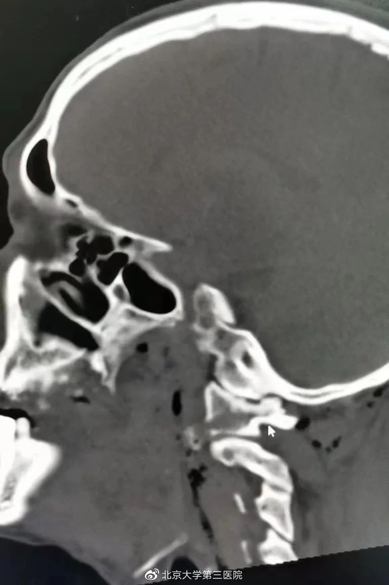 钢钉穿心脏紧急营救,钉子贯穿男子左胸因心脏偏右得救