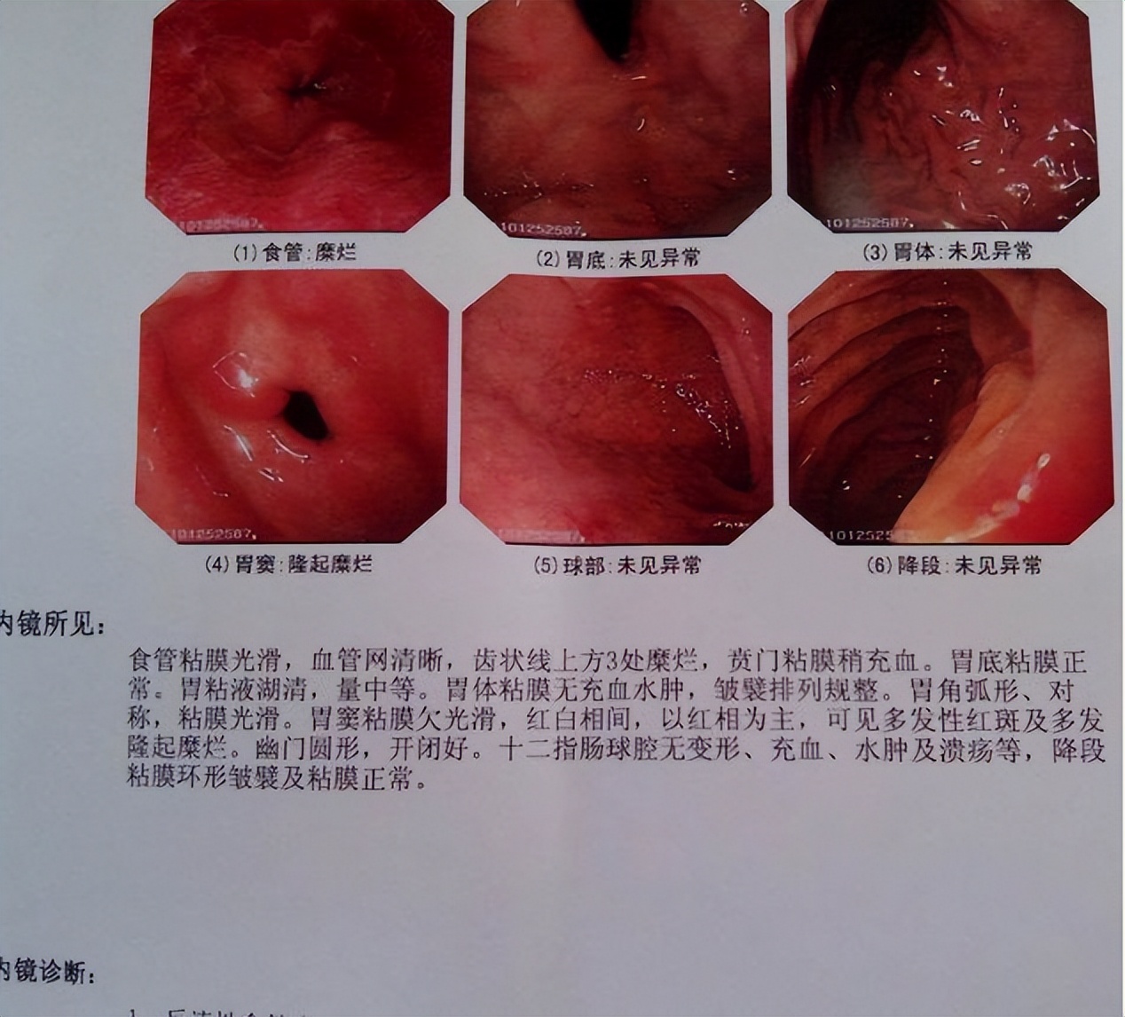 做完胃镜怎么看报告,做完胃镜怎么看胃有没有问题
