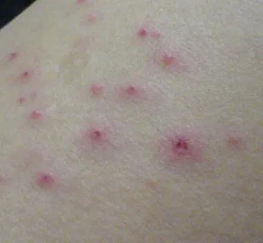 湿疹性皮炎能治好吗,参椒汤能治好湿疹吗