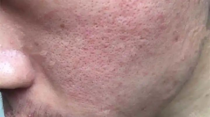 维a酸乳膏可以改善毛孔粗大吗,油皮毛孔粗大黑头多要怎么改善