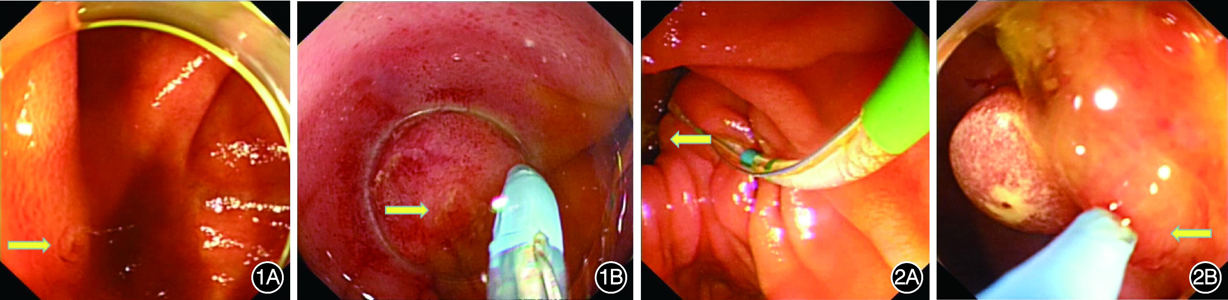 直视镜下经内镜逆行胰胆管造影术困难憩室乳头插管3例