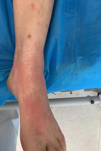 蜂蜇伤如何处理,蜂蜇伤最佳处理方法