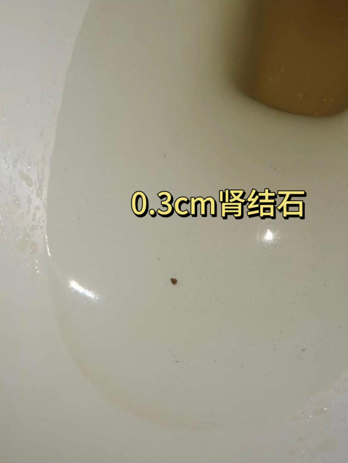 肾结石1.2厘米结石最快的排出方法,0.3-0.5的结石有多大图片