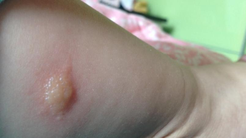 10个月宝宝腿上长了个硬包块,100天宝宝腿上突然长很多疙瘩