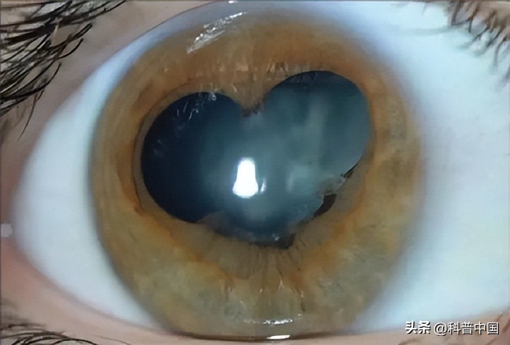 得了新冠瞳孔大小会变吗,新冠后遗症瞳孔三角形