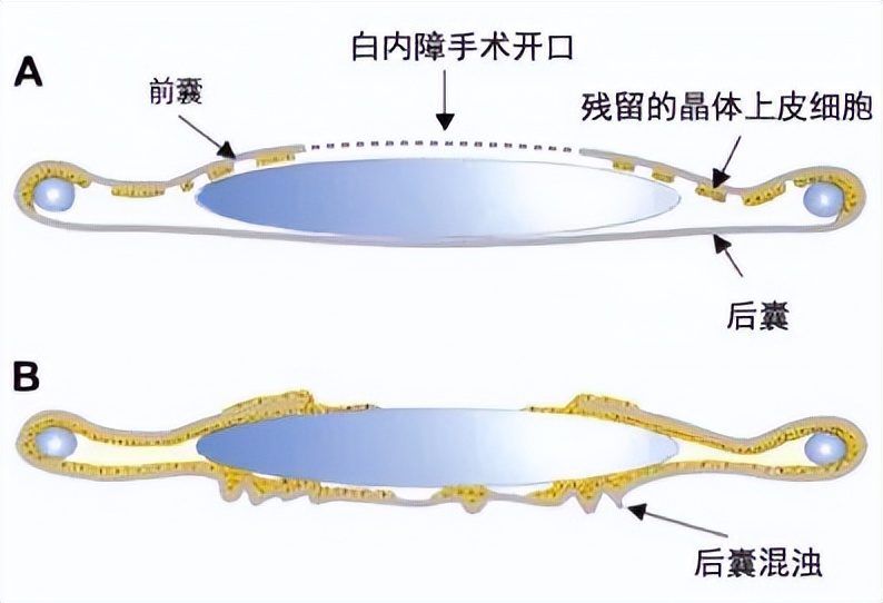 白内障手术失败的眼科医生,上海眼科医院白内障