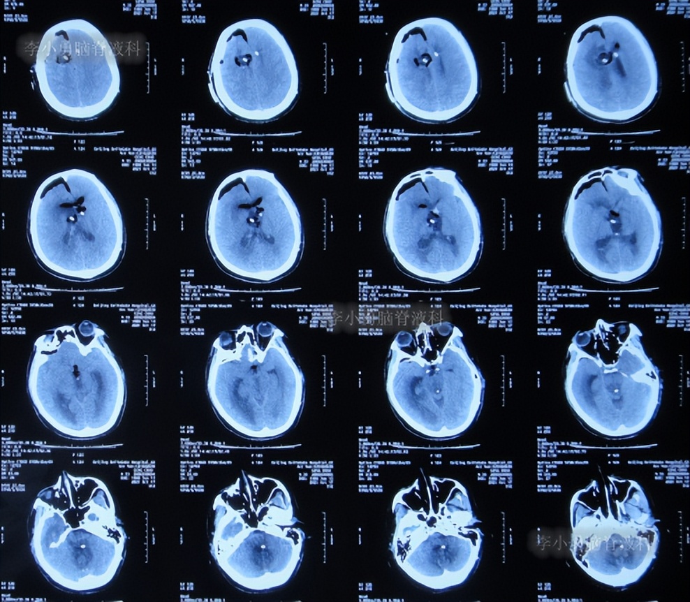 脑积水三脑室造瘘多久能恢复,脑囊虫手术后脑积水