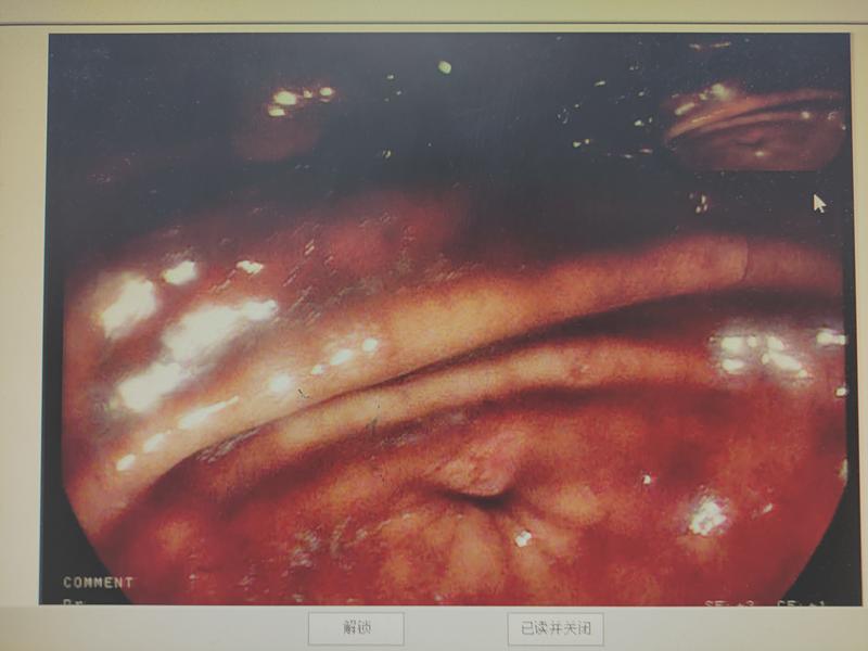 27岁男子消化道出血,陕西小伙消化道大出血