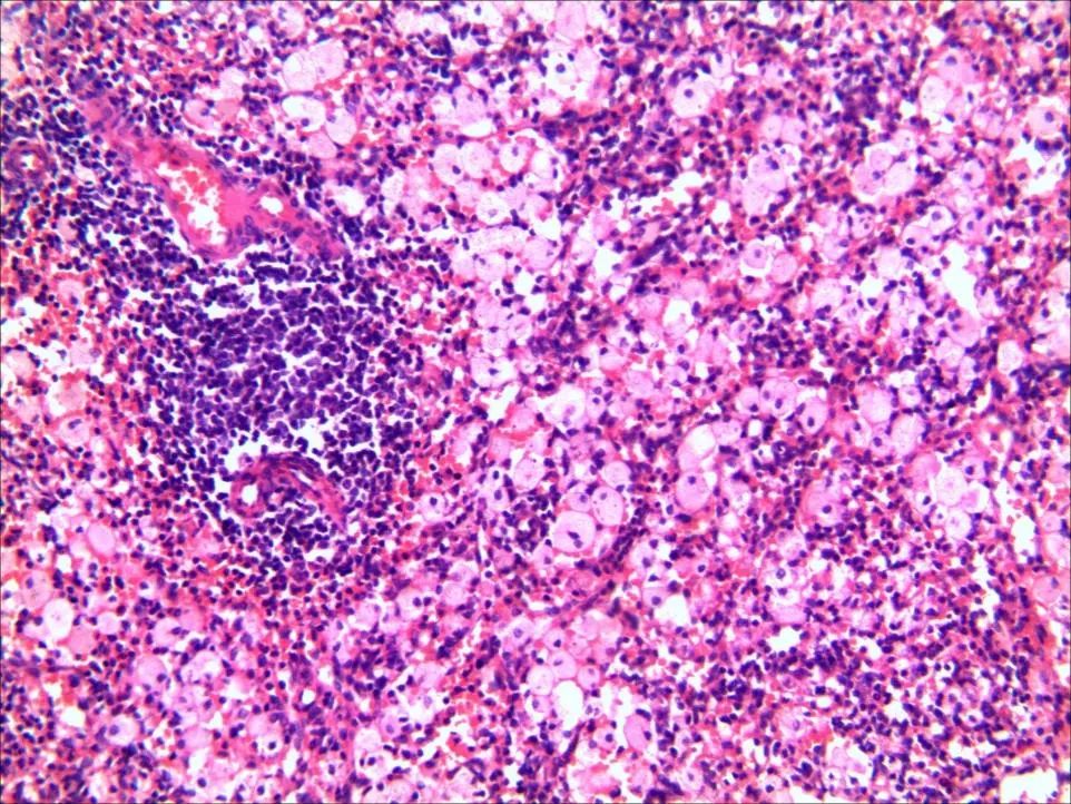 慢性乙肝患者牙龈出血意味着什么,乙肝抗病毒后牙龈出血是什么原因