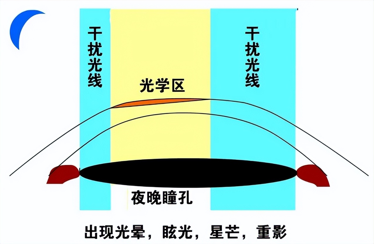 「专家解答」佩戴ok镜后孩子为什么感觉叠影和眩光？