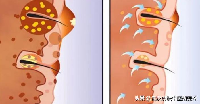 痘痘疼怎么回事,痘痘里有硬块不冒脓怎么办