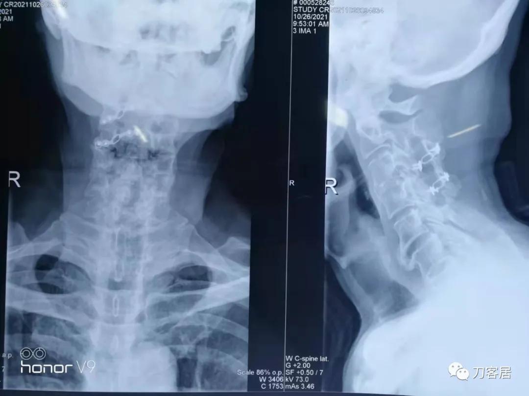 颈椎椎管内肿瘤手术20例麻醉处理,颈椎脊髓内肿瘤手术成功案例