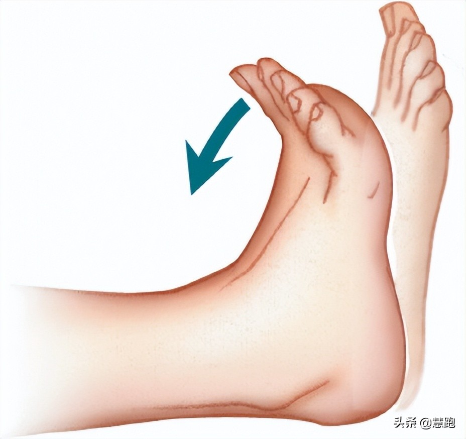 足底筋膜炎久治不愈怎么办,为什么足筋膜炎久治不愈