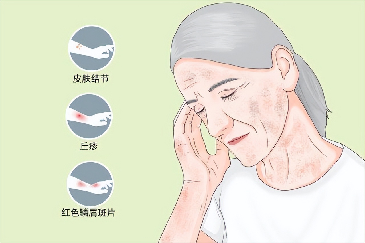 鼻子上长痣能变成细胞癌吗,脸上的痣是基底细胞癌吗