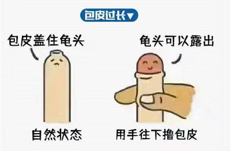 小儿包茎最佳手术年龄,关于儿童包茎手术新闻