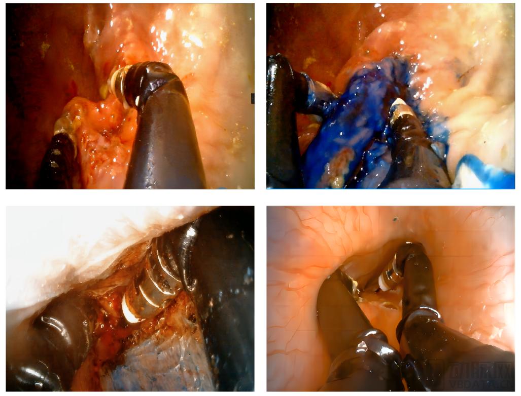 自然腔道手术机器人,人工智能手术机器人视频