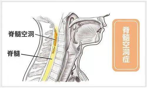 脊髓空洞症核磁会误诊吗,核磁显示脊髓空洞是什么意思
