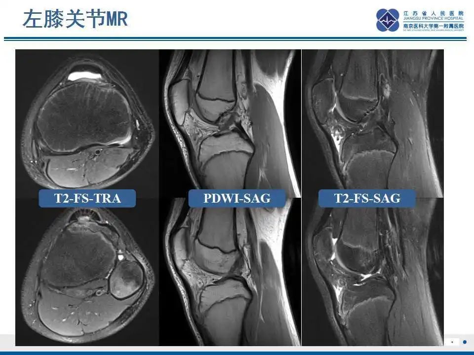 胫骨结节软骨炎要怎么治疗,胫骨结节骨软骨炎会癌变吗