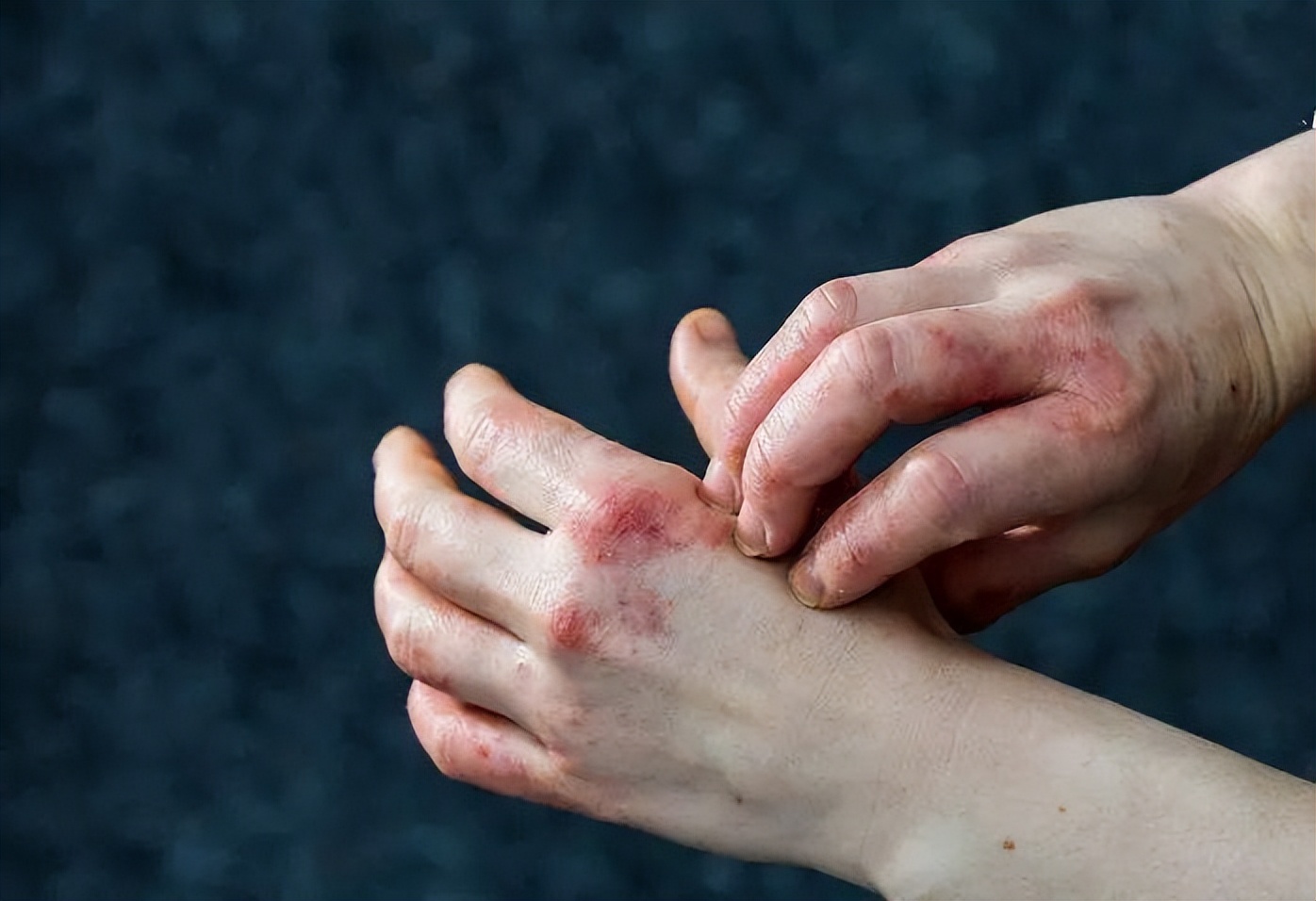 汗疱疹特别痒的时候怎么办,为什么汗疱疹反复发作呢怎么治疗