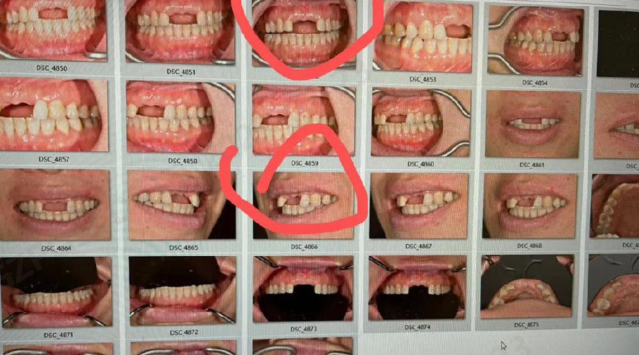 种植牙之前你一定要搞清楚这7件事？
