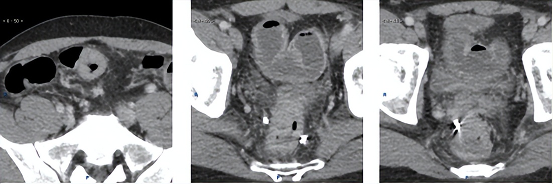 多原发癌症转移,多原发直肠癌