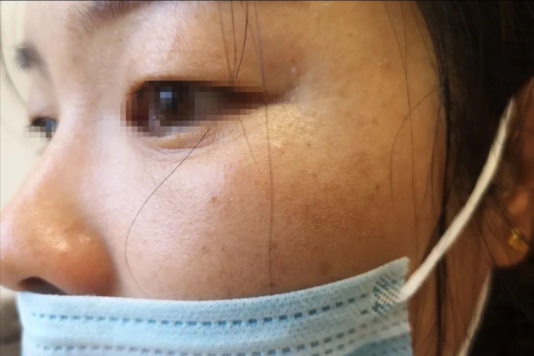 炎症后皮肤黑黑的,怎么办?