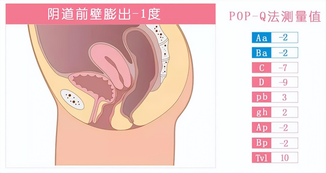 掉出来的痔疮是内痔吗,掉出来