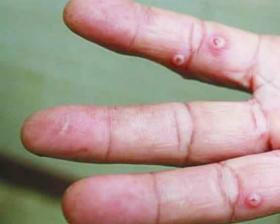 红火蚁被蜇伤的视频,被红火蚁咬哪里最危险