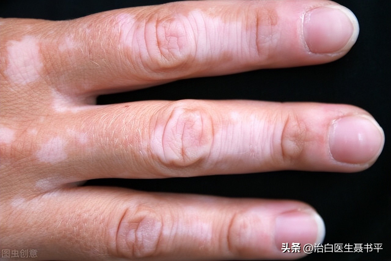 不同部位的白癜风治愈概率不同,白癜风节段型与寻常型哪种稳定