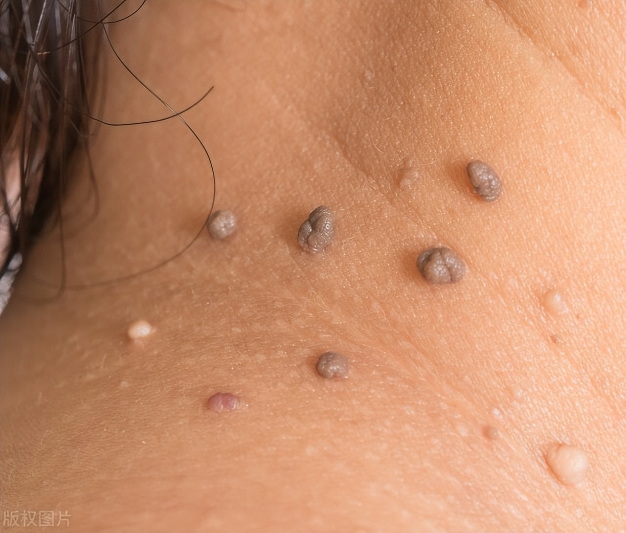 怎么样才能治好颈部小肉球,脖子里面的小肉球能自愈吗