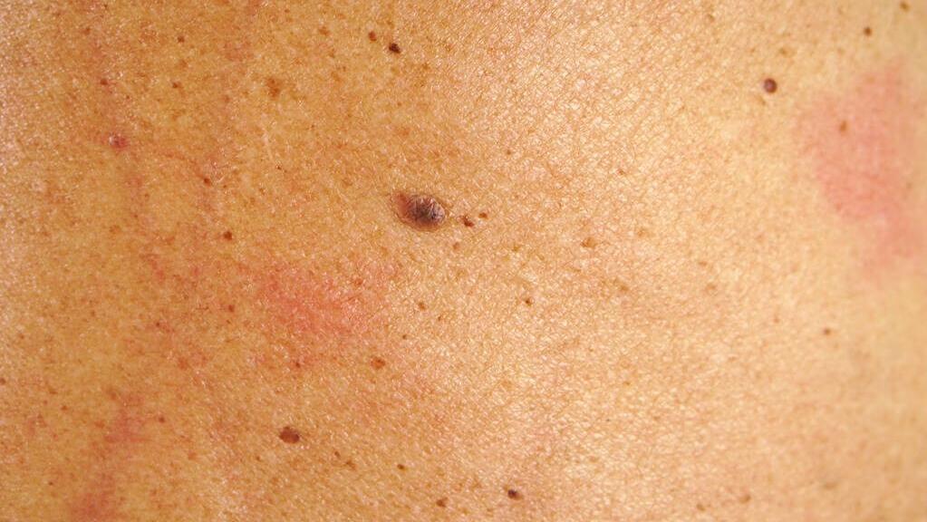 脸上长黑斑是癌症的前兆吗,脸上的黑斑会成皮肤癌吗