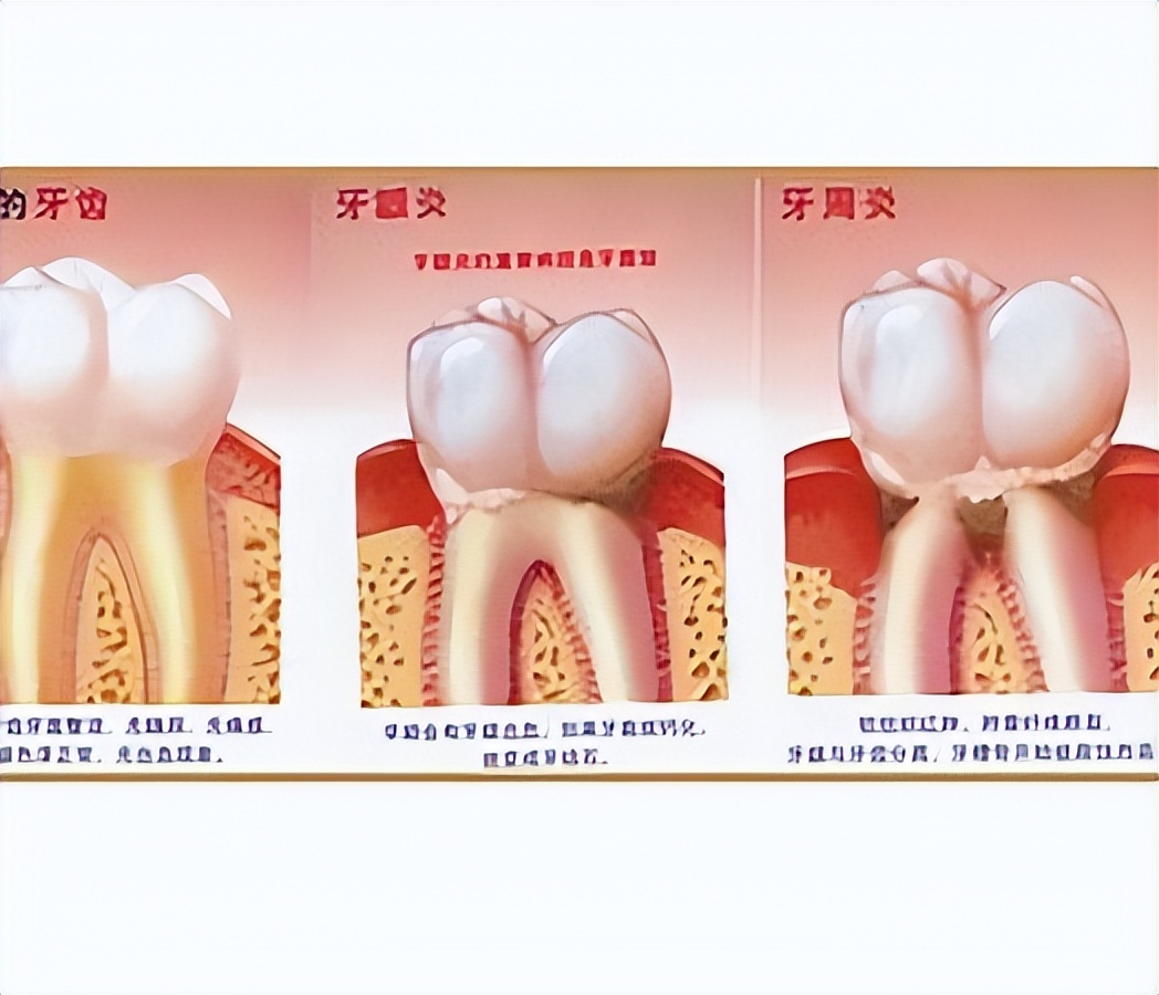 牙周病到底是什么样子的,牙周病是怎样出现的你知道吗