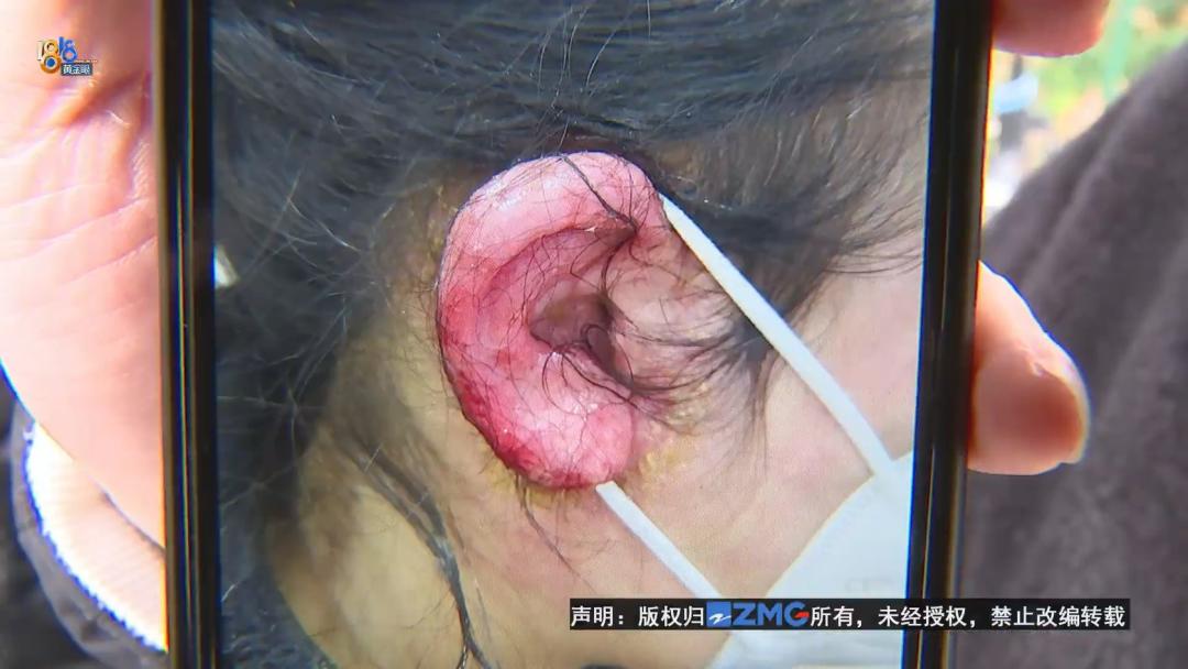 湿疹打针能好吗,湿疹用蛋白埋线效果不如两支药膏